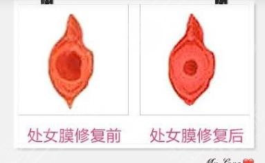 处女磨修复