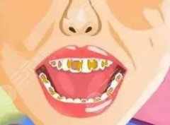 四环素牙齿如何美白？四种洁牙方式介绍！看看你想要哪一种呢！