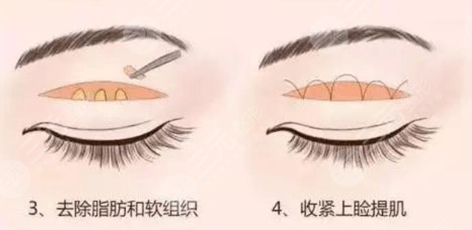 双眼皮
