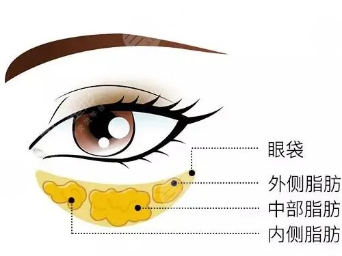 怎么去眼袋快有？