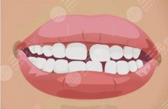 门牙缝隙越来越大怎么办？造成牙缝变大的原因及有的缓解方案透露~