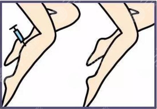 瘦小腿有的方法有哪些?见快且操作简单的方案,长期坚持果惊艳~