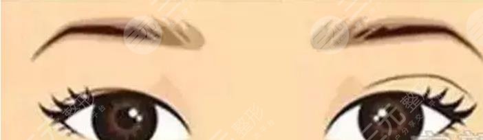 眼部整形