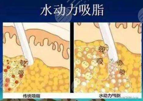 水动力吸脂