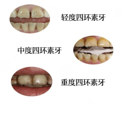 四环素牙如何改良?