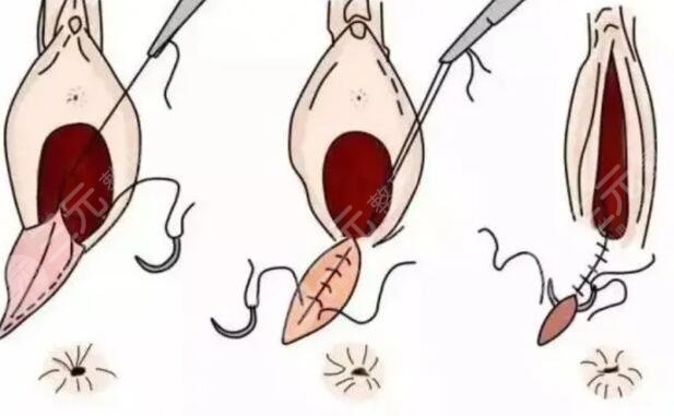 处女膜修复多少钱才合理？