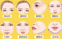 额头有抬头纹怎么办,怎样去皱纹?分享除皱指南,美力UP! 额头有抬头纹怎么办,怎样去皱纹?分享除皱指南,美力UP!