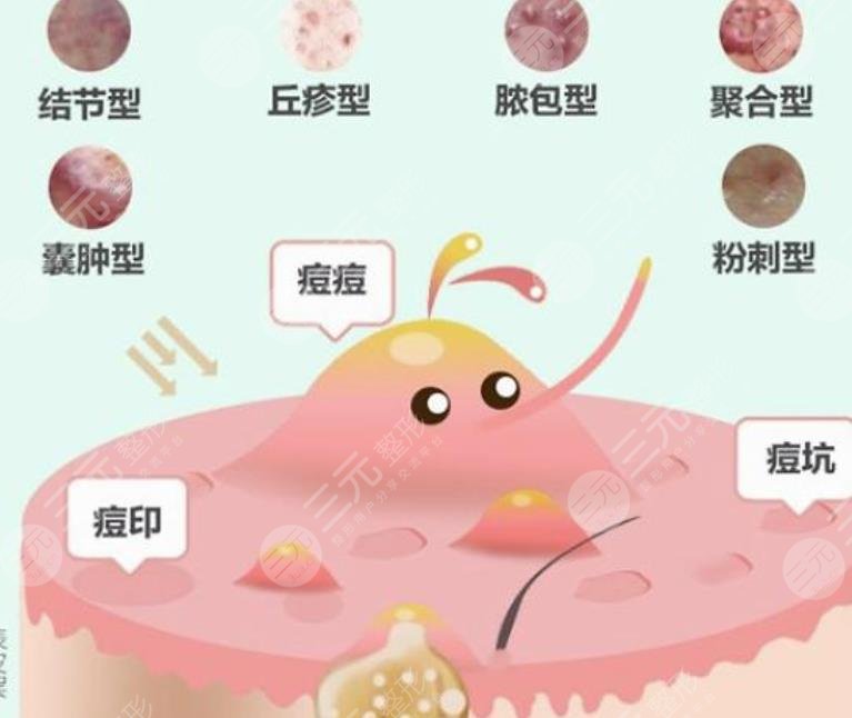 痤疮