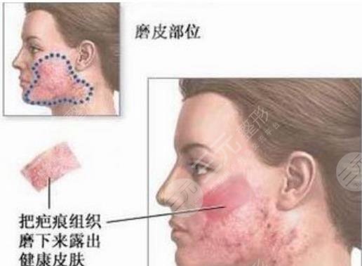 皮肤磨削术
