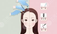 【植发】发际线高怎么治？发际线过高植发需要多少钱？