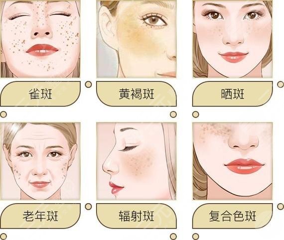激光能治黄褐斑吗?