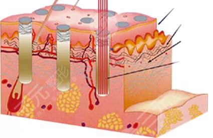 光子去痘有用吗?原?理介绍