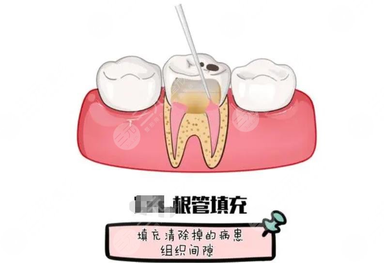 根管缓解一颗牙多少?钱?