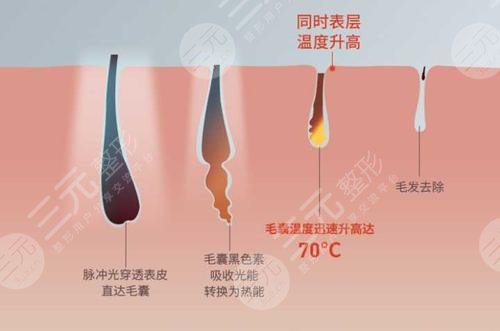 脱毛嫩肤的方法有哪些？