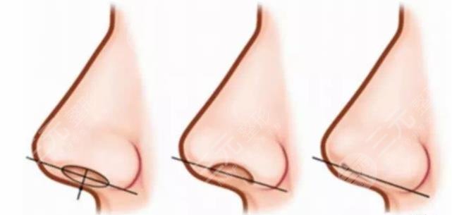 鼻翼缩小