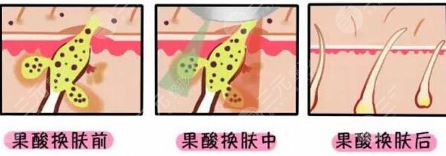 果酸换肤