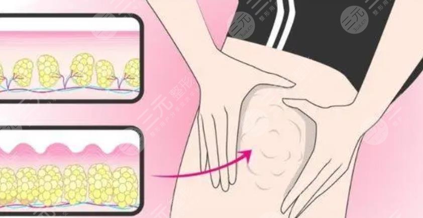 小腿吸脂