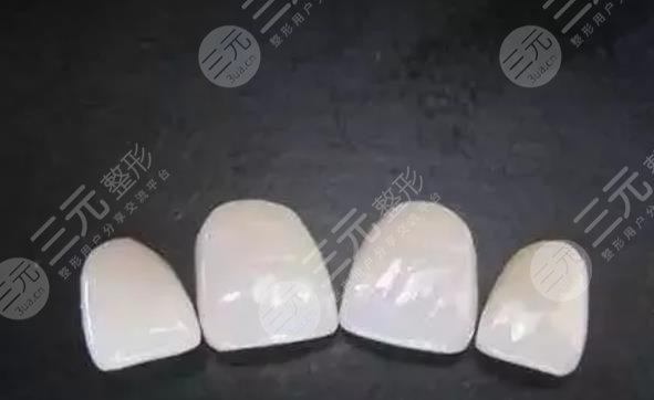 全瓷牙贴面