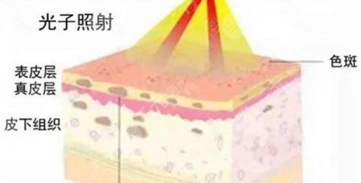 光子嫩肤