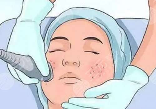 怎样祛斑果好些?