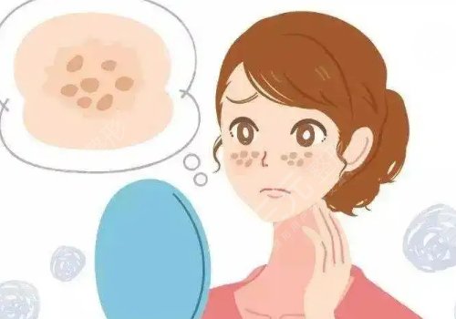 怎样祛斑果好些?