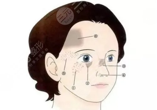 褐青色斑是怎么形成的?