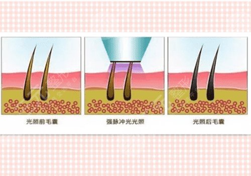 光子脱毛需要几次能脱干净?