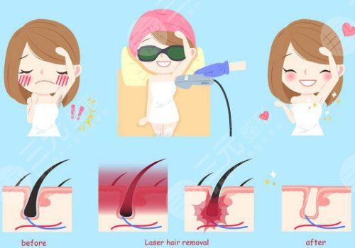 光子脱毛需要几次能脱干净?