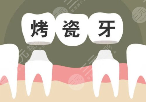 烤瓷牙价格表2023更新