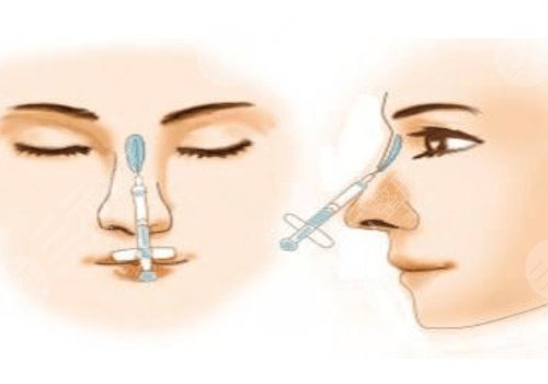 硅胶假体隆鼻一般维持多久?