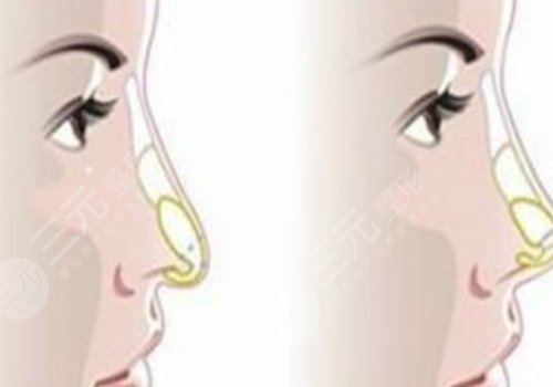 硅胶假体隆鼻一般维持多久?