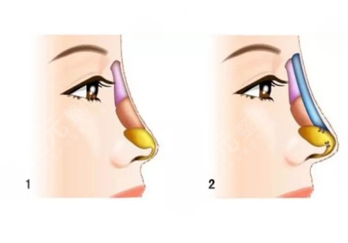 硅胶假体隆鼻一般维持多久?
