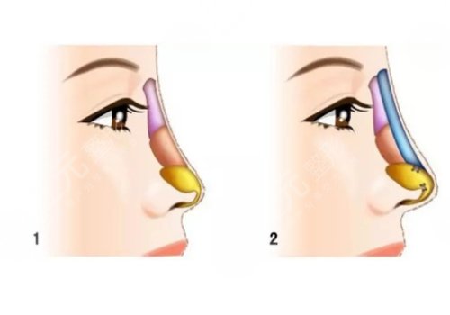 硅胶假体隆鼻一般维持多久?