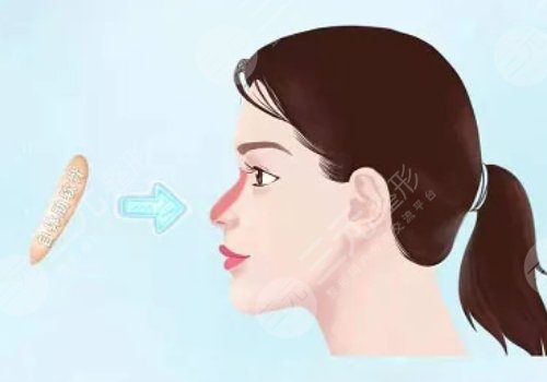 硅胶假体隆鼻一般维持多久?