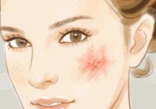 脸蛋红血丝怎么治?