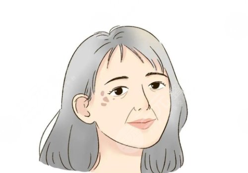 怎样治老年斑？