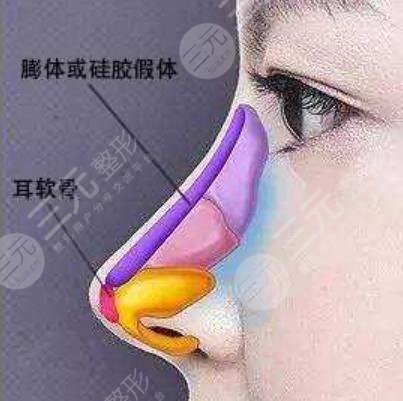 硅胶隆鼻