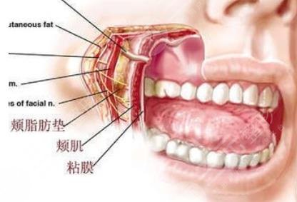 去颊脂垫手术介绍