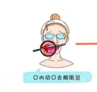 去颊脂垫手术介绍