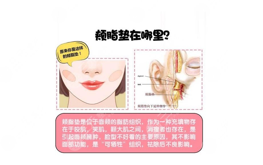 去颊脂垫手术介绍