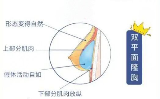麦格假体的优势性