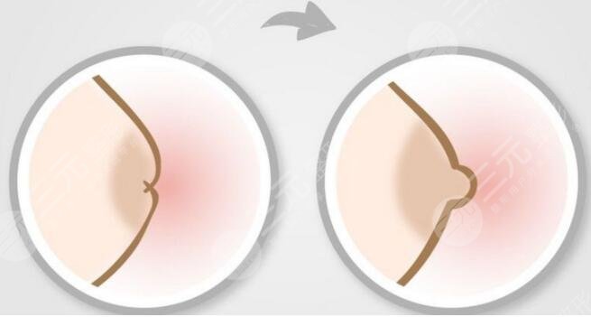 乳头内陷怎么办？手术矫正方法又有！日常生活怎么正确护理胸部？