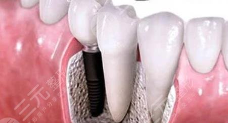 牙齿种植
