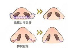 鼻翼整形的价格2023年同步更新，术式、术后效果、手术注意事项实情告知~