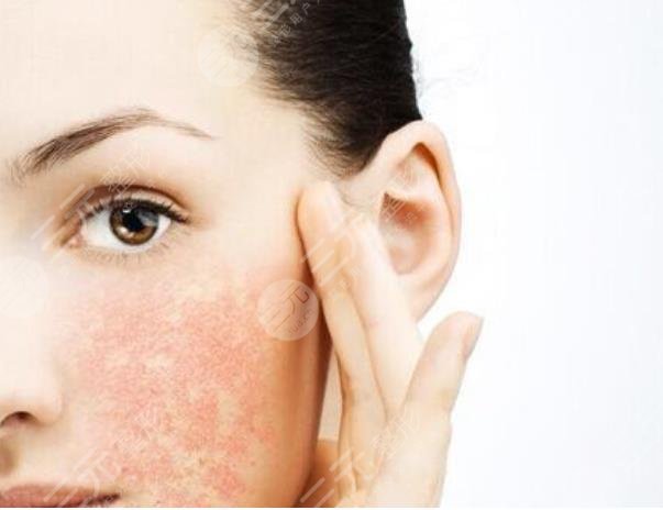 敏敏肌如何修复?