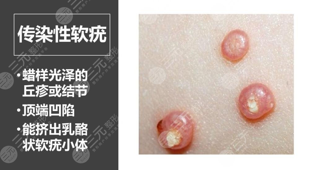 猴子是什么皮肤病?