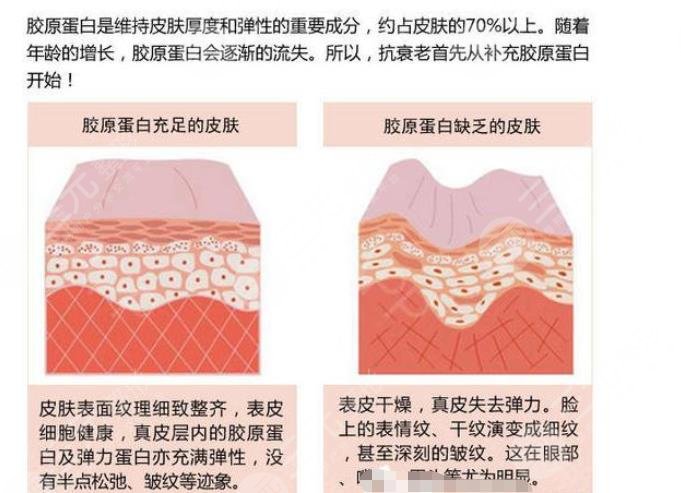 哪种胶原蛋白好?