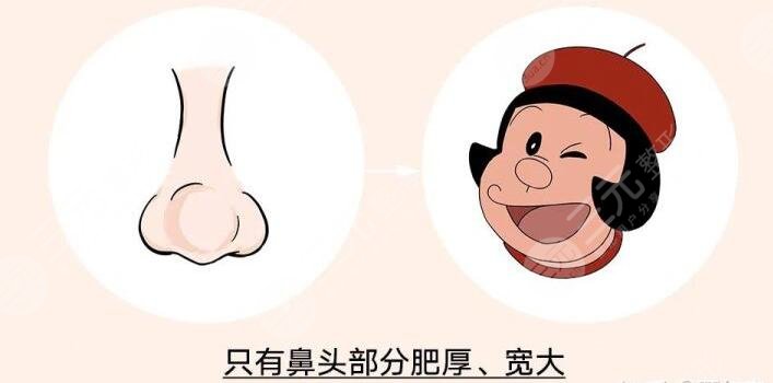 　　蒜头鼻整形前后对比，小编通过调查了解到，有许多小伙伴正在饱受蒜头鼻带来的不好的影响，蒜头鼻又被称为大鼻头，无论男生还是女生，一旦长成蒜头鼻，就会让整个人看起来面部的不协调，影响美观程度，而且如果鼻头很大的话，咱们看这个人的大部分眼光就会集中在鼻头，并且忽略面部其他地方。除此之外，蒜头鼻的小伙伴们在化妆的时候也会感到特别烦恼。所以有一些小伙伴会去做蒜头鼻整形手术，收获一个小巧好看的鼻头。  　　一、蒜头鼻整形手术原理  　　蒜头鼻的形成原因是因为鼻头部分的脂肪组织比较厚，鼻翼的软骨发育过度或者鼻翼软骨发育过程中往后缩，从而造成了蒜头鼻。在进行蒜头鼻矫正手术的过程当中，医生是通过切除鼻子部分多余的软骨和脂肪组织，然后将鼻头聚拢缝合，在伤口愈合过后，就可以收获一个又细又直的小巧好看的鼻子。这类手术的切口微小，伤口不，愈合过后也不容易看出切口的痕迹，爱美的小伙伴可以详细去了解蒜头鼻整形手术，判断自己的鼻头形状，再进行手术改良。  　　二、蒜头鼻的分类  　　首先咱们的鼻翼软骨发育过度会导致蒜头鼻，这样的蒜头鼻整个人的鼻头看起来又大又大，的不好看，但是改良的方法是比较简单的，可以直接将发育过度的鼻翼软骨切除掉，或者可以将鼻翼软骨聚拢再缝合，也能达到收缩鼻翼的果。其次是鼻头的软组织肥厚，造成的蒜头鼻，这种蒜头鼻的特征是，起来肉乎乎的软绵绵的。  　　要进行手术调整的话，就需要切除鼻子的部分软组织，这种改良手术考验医生的手术技术，如果医生在手术过程当中操作不当的话，就很可能会导致鼻头的软组织增生，会让鼻头越来越大，变成大蒜头鼻。后就是鼻尖很矮，就会显得鼻头很塌，这类蒜头鼻就不需要切除鼻部组织，可以通过抬高鼻尖来达到缩小鼻翼的果，这类改良方式是相对来说简单的。  　　三、蒜头鼻整形前后对比  　　小编的大学室友就是一个典型的蒜头鼻女孩，不看鼻头的话，她皮肤白皙有光泽，眼睛大双眼皮嘴巴小巧，脸型也是标准的鹅蛋脸，看起来的好看，但是美中不足的是，她的鼻头看起来的大，肉嘟嘟的，也就显得她的山根很低，这就使得她的颜值降低了百分之五十，特别是嘴巴小巧就更显得鼻头大，整个人看起来就不再精致，显得比较憨厚老实。前段时间，她在朋友的推荐下，准备通过整形手术来改良自己的蒜头鼻。  　　她讲述到，她去到了整形医院，整形医生根据她的鼻头设计了切除鼻部多余软组织的手术方案。医院安排了一位临床经验丰富的整形医生，为她进行了切除鼻部软组织的手术。术后一周左右，她发现自己的鼻头没有肿胀感了，整体的恢复也比较快，她自己也感觉到鼻头的缩小了。  　　术后一个月左右，她的鼻子已经变得的好看，因为肉肉的鼻头被切除缩小了，也就让她的山根显得高挺起来，鼻头变得小巧精致，整个人的颜值大大的提升，从一个面相憨厚的女生变成了大美女。她本人也变得更加自信，以前拍照只敢露半张脸的她，现在拍照能够大大方方露全脸，不用再因为自己的蒜头鼻被家人朋友嘲笑了。  　　小编希望所有和我大学室友有相同困扰的小伙伴，可以勇敢的面对自己的蒜头鼻，自信的走进整形医院，做一场适合自己的蒜头鼻整形手术，从根本上改良自己的颜值，让自己也能在自己的生活圈里面自信放光芒。