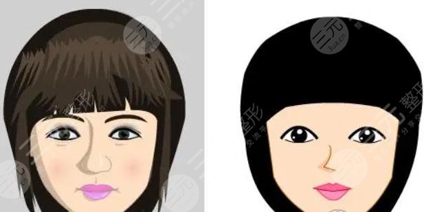 蒜头鼻整形前后对比