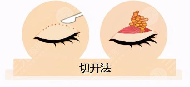 什么是切开法双眼皮?